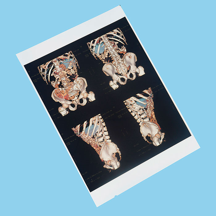 醫(yī)用打印膠片